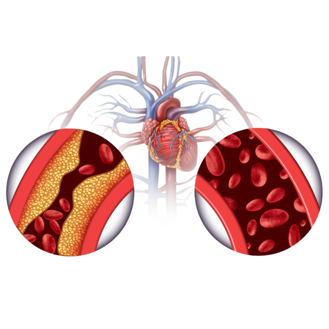 Miażdżyca – cichy zabójca. Sprawdź, jakie badania wykonać